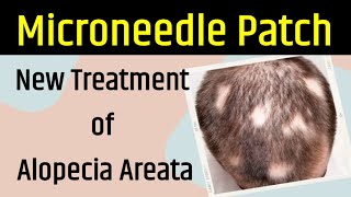 Microneedle Patch  New Treatment of Alopecia Areata  Dr Mukesh Aggarwal [upl. by Ragnar234]