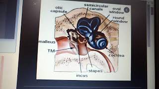 OTOSCLEROSIS very IMPORTANT concept made easy part 1 [upl. by Dachia]