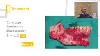 Ameloblastoma Dr MuhyAldeen Tutunjy [upl. by Odlabso]