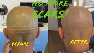 How To Get Rid of Hair Transplant Scars [upl. by Yralam341]