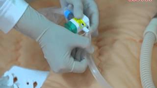 Pediatric Color Coded Y Closed Suction Catheter [upl. by Asatan]