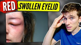 Swollen Eyelid causes amp solutions  Eye Doctor Explains [upl. by Plank]