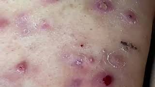 Cystic Acne Cysts Acne Dermatology Comedones and Whiteheads [upl. by Catie161]