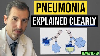 Pneumonia Explained Symptoms Diagnosis Labs Treatment [upl. by Nij]