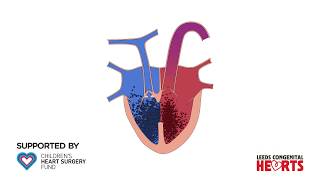 Tetralogy of Fallot [upl. by Haelem329]