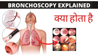 bronchoscopy Explained in Hindi क्या होता है [upl. by Berthe]