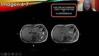 Resonancia Magnética de abdomen [upl. by Hsu]