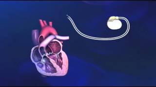 Implantatie van een tweekamerpacemaker  Medtronic [upl. by Ninette]