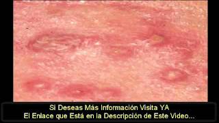 Como Eliminar Herpes Remedios Naturales Cure Su Herpes [upl. by Lois]