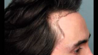 Hair transplant part 7 hair results [upl. by Ardnaxela]