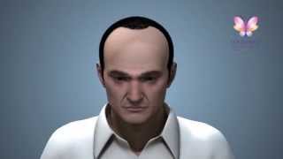 Hair Transplantation Options from Southwest Plastic Surgery El Paso Texas Las Cruces New Mexico [upl. by Iluj]