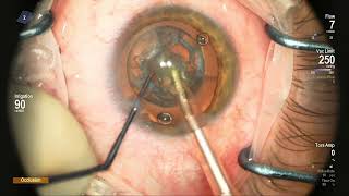 Posterior polar cataract tips and tricks for a safer surgery MiguelRechichieyesurgeon [upl. by Dorsman]