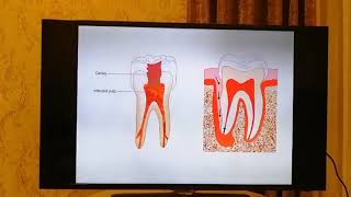 Pulp Disease  what Should I Know Diagnosis Treatment [upl. by Dirk]