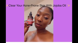 Clear Your AcneProne Skin With Jojoba Oil [upl. by Maryl]