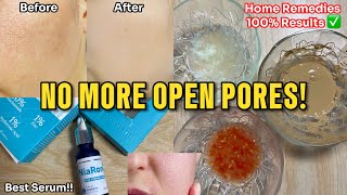 How to get Rid of Large Open Pores Best Home Remedies  Abial openpores [upl. by Serrell]