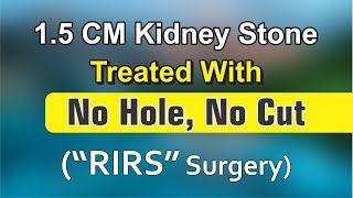 15 cm Kidney Stone Treated with No Hole No Cut Procedure [upl. by Ferree969]