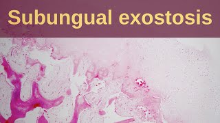 What is a Subungual Exostosis  pathology mini tutorial [upl. by Villiers41]