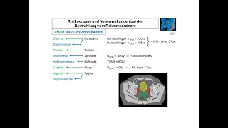 Risikoorgane und Nebenwirkungen beim Rektumkarzinom  Strahlentherapie Prof Hilke Vorwerk [upl. by Solita]