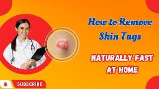 How to Remove Skin Tags Naturally Fast at Home [upl. by Aicat]