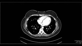 Layers of the Abdominal Wall [upl. by Remlap]