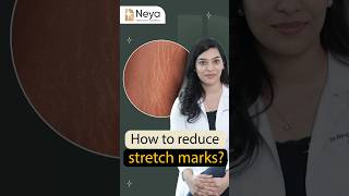 How to get rid of stretch marks  Dr Ravali Yalamanchili  Skin specialist in Hyderabad [upl. by Langer508]