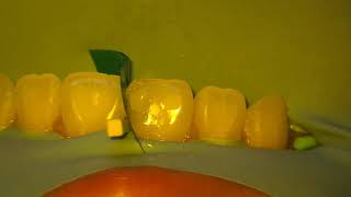 Repairing a Cavity in a Front Tooth [upl. by Toblat]