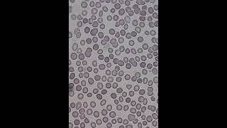 فيديو يوضح خلايا الدم الحمراء المشوكة crenated red blood cells [upl. by Daven692]