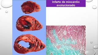 CLASE TEÓRICA 12  PATOLOGÍA CARDIOVASCULAR PARTE 2 [upl. by Dwaine]