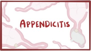 Appendicitis  causes symptoms diagnosis treatment amp pathology [upl. by Hagan]