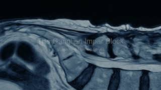 PainExam US Guided Ganglion Impar Block Coccygodynia Pelvic amp Perineal Pain David Rosenblum MD [upl. by Guntar]