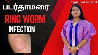 படர்தாமரை Ring Worm Infection  Explained  Why it occurs How to treat  நோயை பற்றி அறிவோம் [upl. by Notla]