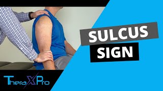 Sulcus Sign  Shoulder Instability [upl. by Pincus358]