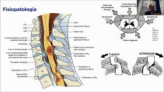 Webinar Enfermedad degenerativa cervical [upl. by Orson]