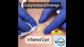 Inflamed Cyst Incision amp Drainage [upl. by Yks]