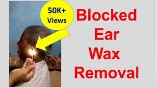 Hearing Loss Due to Massive Earwax  Blocked Ear Wax Removal [upl. by Etnovaj]