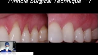 What is the Pinhole Surgical Technique® a SurgicalMaster™ QuickLecture [upl. by Rennold396]