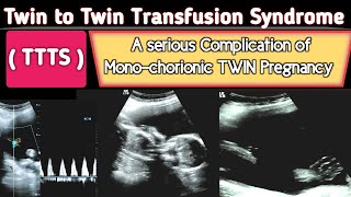 TTTS  Twin to Twin Transfusion Syndrome Ultrasound  A Serious COMPLICATION [upl. by Ayifa]