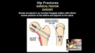 Cemented or Uncemented Hemiarthroplasty for Intracapsular Hip Fracture The WHiTE 5 randomised trial [upl. by Ihp]