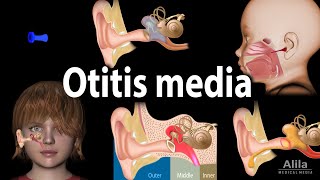 Otitis Media Anatomy Pathophysiology Risk Factors Types of OM Symptoms and Treatment Animation [upl. by Aikahc25]