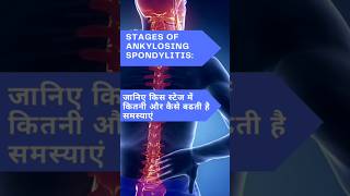 ankylosingspondylitis stagesofankylosingspondylitis ankylosingspondylitistreatment [upl. by Candi]