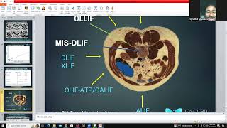 Inspired Spine July case conference  Post OLLIF Neuritis  risk factors presentation management [upl. by Waylan]