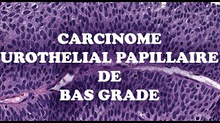 LE CARCINOME UROTHELIAL PAPILLAIRE DE BAS GRADE – PATHOLOGIE [upl. by Bourn]