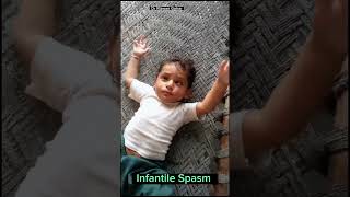 Infantile Spasm fits seizures infantilespasm epilepsy treatment [upl. by Drolyag502]