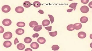 Hematology Clinical Case  1 Anemia amp Size of Cell by MedicAids [upl. by Januisz695]