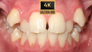 🤔HOW BRACES WORK Amazing TRANSFORMATION  TIMELAPSE four premolars extraction case Orthodontics❗ [upl. by Slemmer]