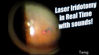 Laser Iridotomy in Real Time with Laser Sounds Chris Teng MD [upl. by Sharona]