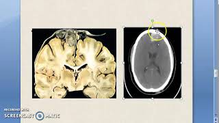 Pathology 899 a Meningioma Tumor IntraCranial Merlin NeuroFibromatosis Arachnoid Meninges [upl. by Rodama]