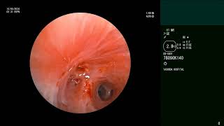 Tuberculosis  Endobronchial Stenosis  Bronchoscopic recanalisation [upl. by Gibbeon]