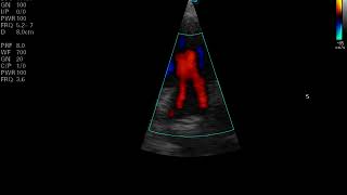 Ecocardiografía Doppler color [upl. by Clova366]