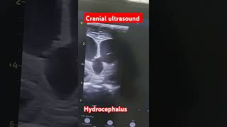 Cranial ultrasound showing rapidly progressive postmeningitic hydrocephalus in a preterm neonate [upl. by Ann]